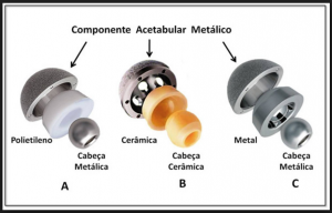 Artroplastia Total do Quadril5