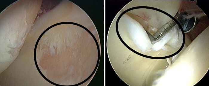 Artroscopia de quadril - lesão de cartilagem e Lábrum