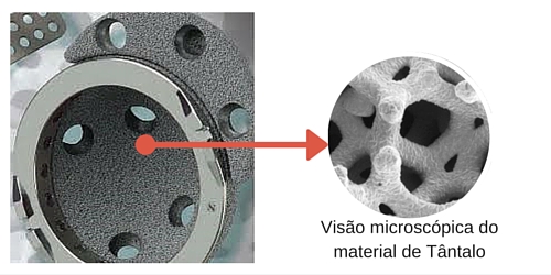 Revisão de prótese - Tântalo com Visão microscópica do material