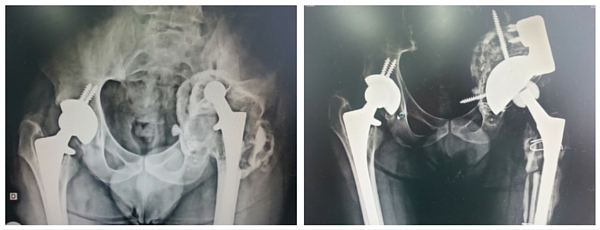 Revisão de prótese e reconstrução de graves falhas ósseas A e B