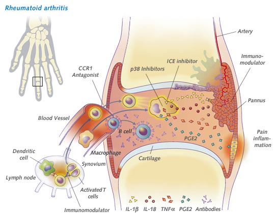artrite e artrose - evolução da reação inflamatória